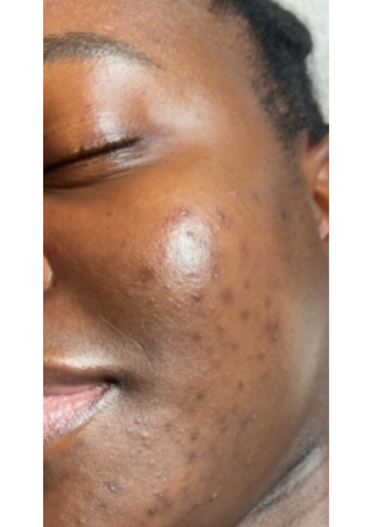 Peau avec taches d'hyperpigmentation