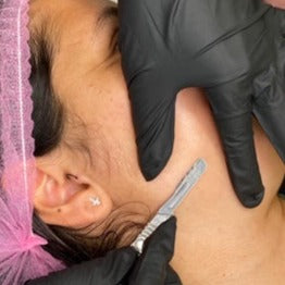 DERMAPLANING